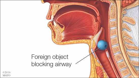 Home Remedies: When someone is choking - Mayo Clinic News Network