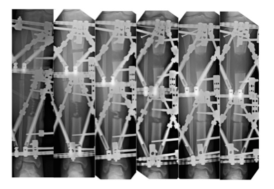 x-ray of Jessica Nelson's leg transport