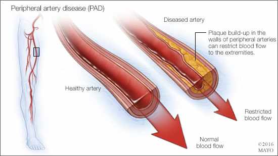 a medical illustration of a healthy artery and one with peripheral artery disease (PAD)