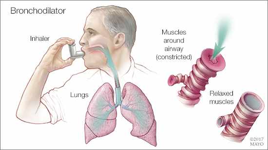 a medical illustration of a man using a bronchodilator to relieve constricted airways
