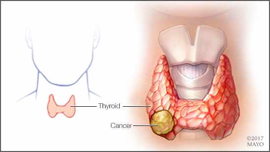 a medical illustration of thyroid cancer