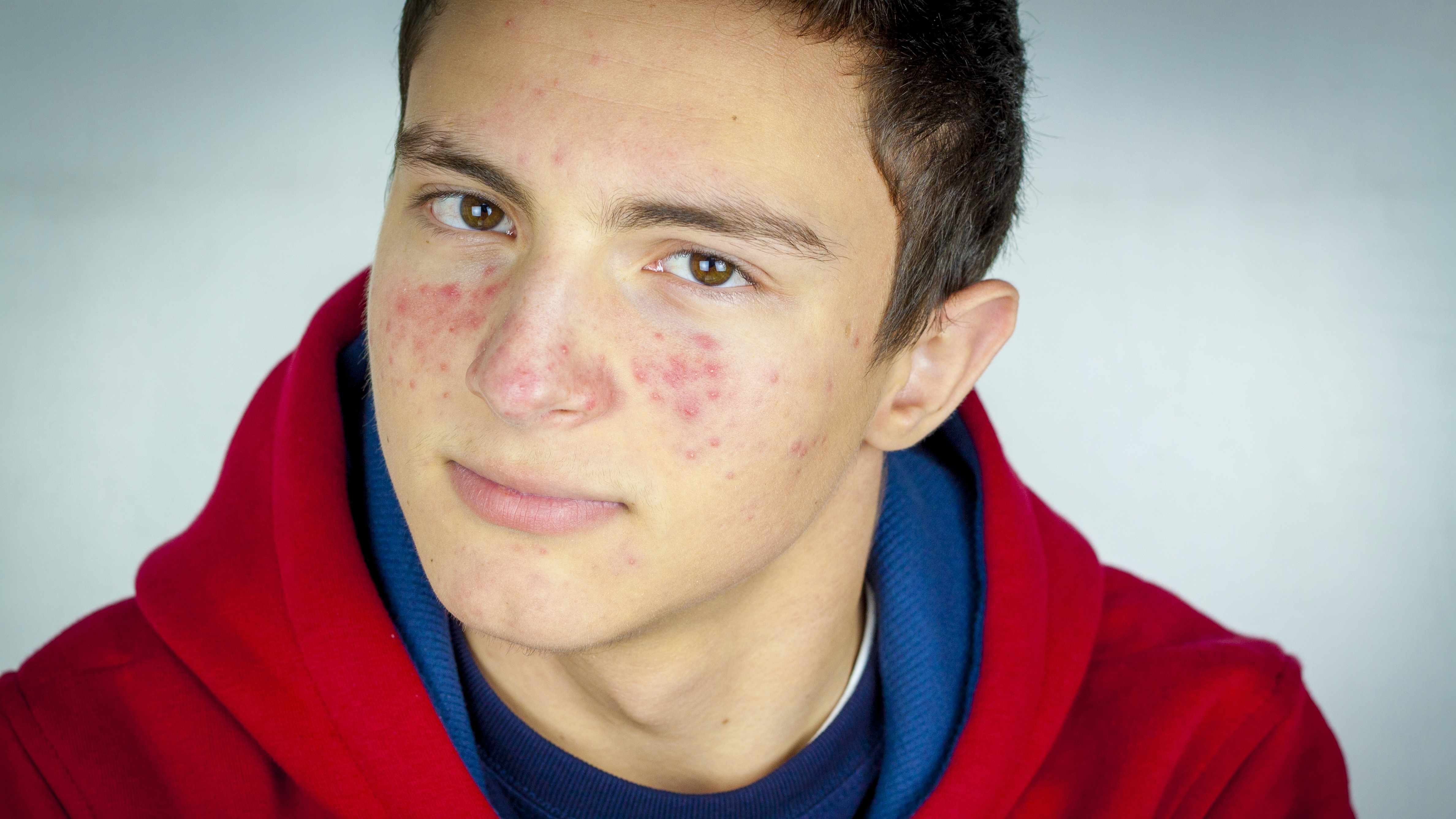 young teenage boy looking serious with acne on his face