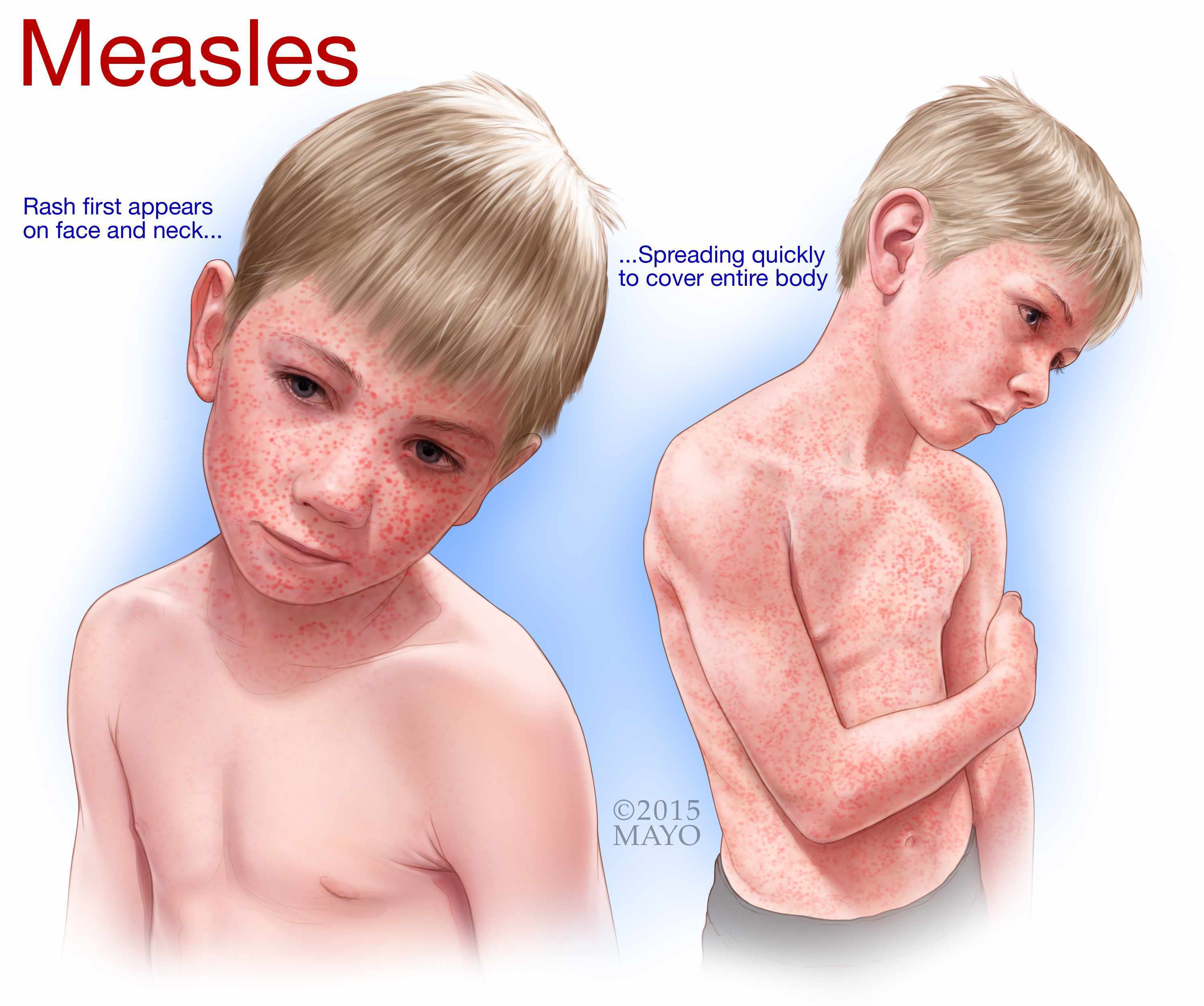 measles rash face