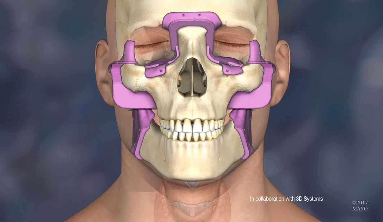 Medical illustration of face transplant