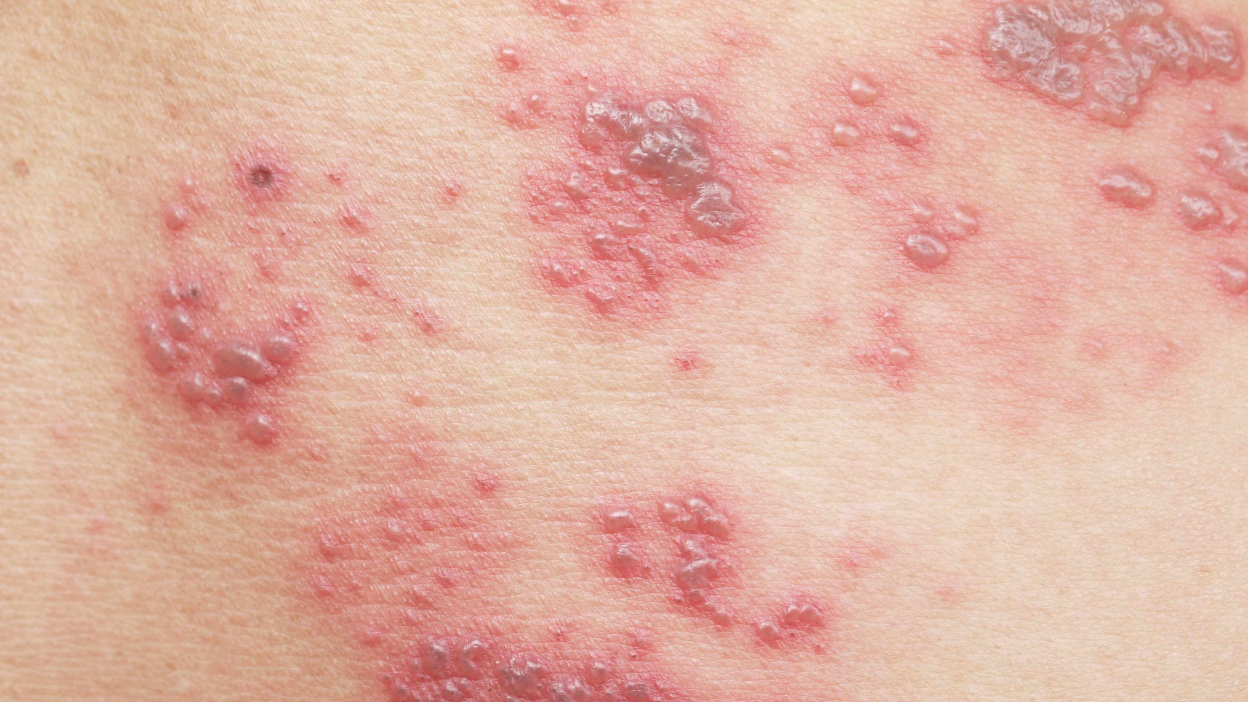 a closeup of red bumps and shingles blisters