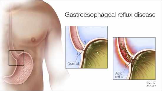 a medical illustration of gastroesophageal reflux disease
