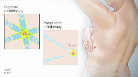 a medical illustration of standard radiotherapy and proton beam radiotherapy