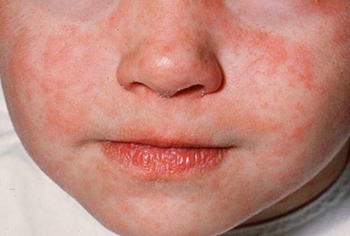 red splotches, measles on a little child's face