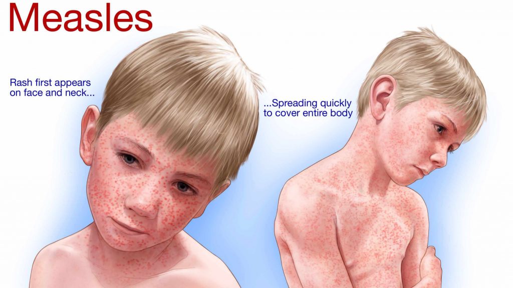 medical illustration of child with measles