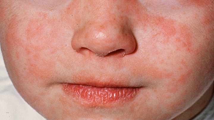 close up of child's face with measles