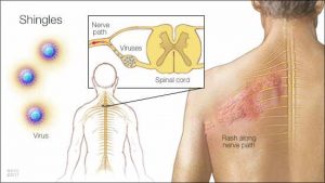 Shingles Inferior Housecall: Understanding shingles - Mayo Clinic News Network