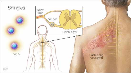 medical illustration of the shingles rash along a man's back
