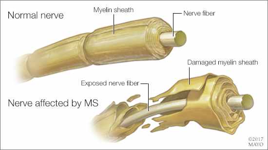 Ilustración médica de un nervio normal y de otro afectado por EM