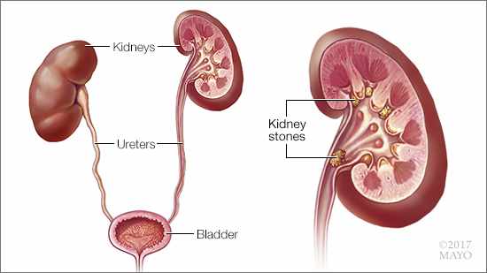a medical illustration of normal kidneys, ureters and bladder, as well as a kidney with kidney stones