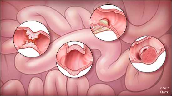 a medical illustration of small bowel cancer