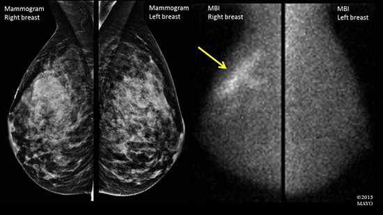 Medical illustration of the difference in appearance between a mammogram image and that of molecular breast imaging (MBI)