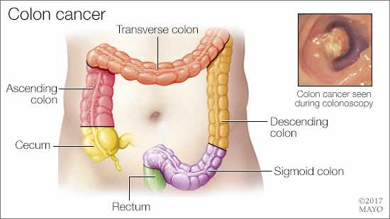 a medical illustration of the rectum, sigmoid colon, descending colon, transverse colon, ascending colon and secum, as well as an image of colon cancer seen during colonoscopy