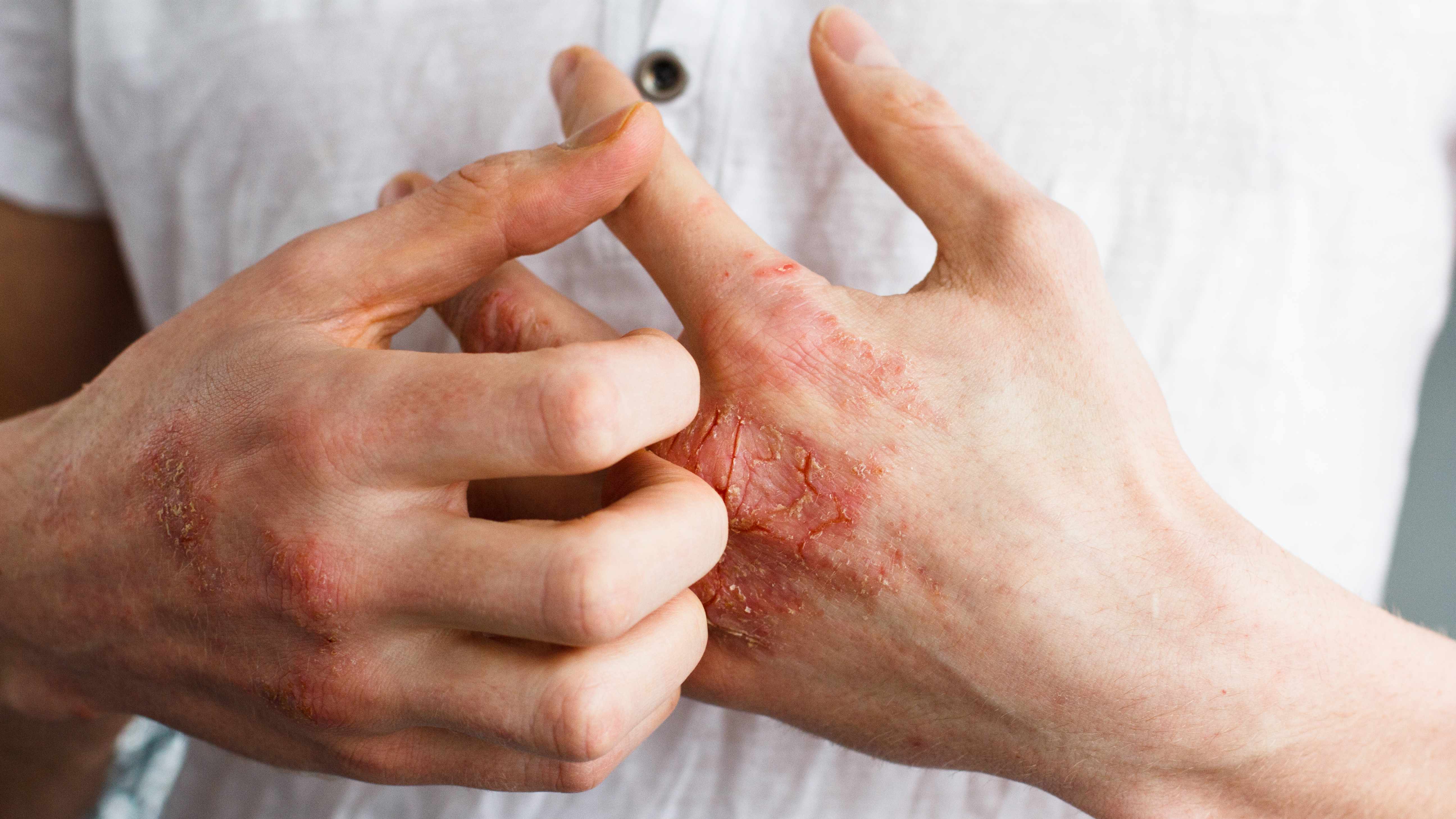 a person with eczema scratching the itchy skin