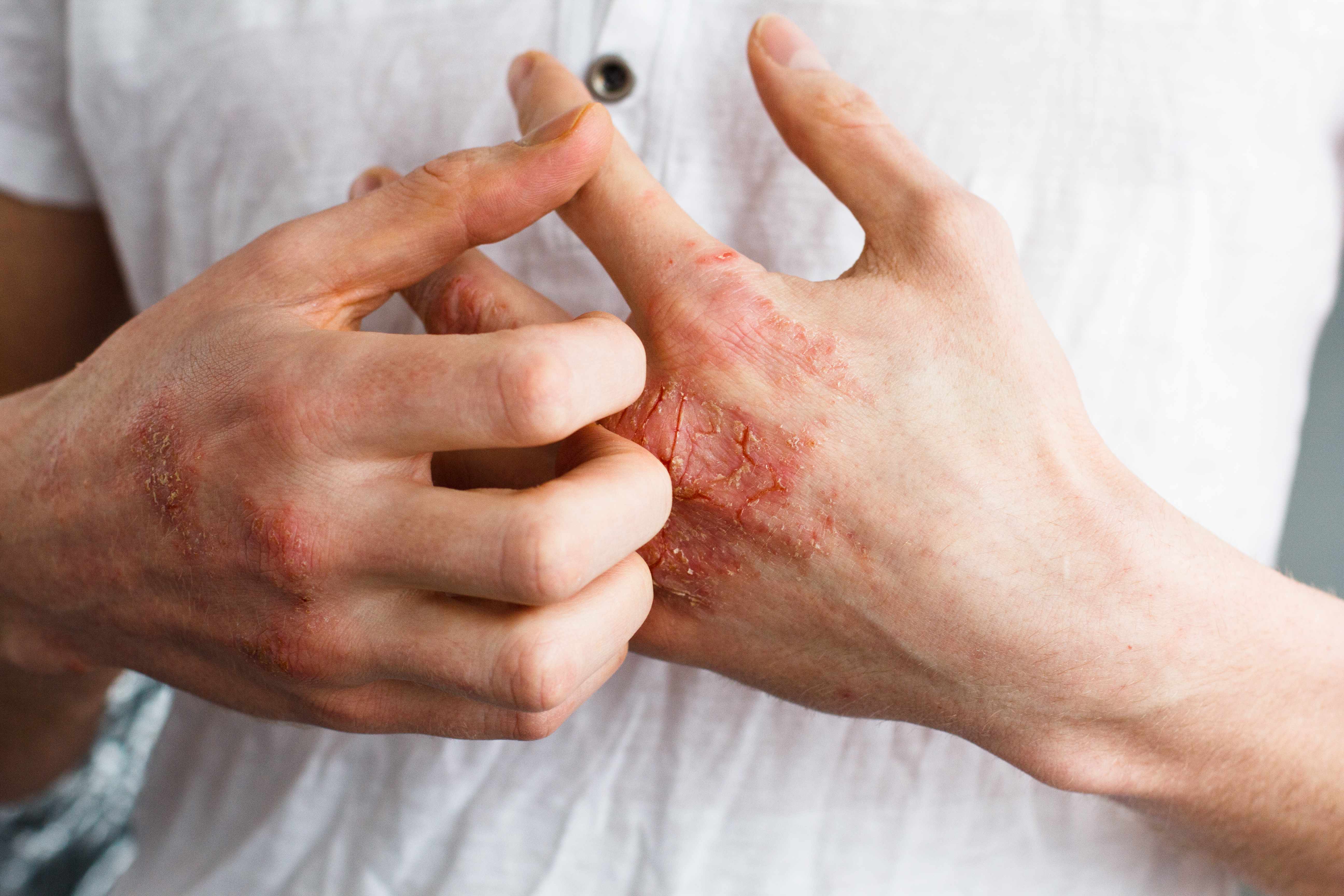 a person with eczema scratching the itchy skin