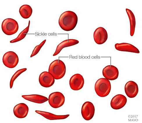 medical illustration of red blood cell and abnormally shaped red sickle cells