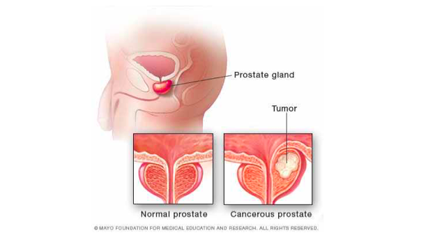 Medical illustration of normal prostate and cancerous prostate