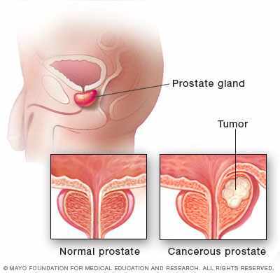 Medical illustration of normal prostate and cancerous prostate