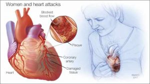 Mayo Clinic Q and A: Heart attack symptoms in women - Mayo Clinic News ...