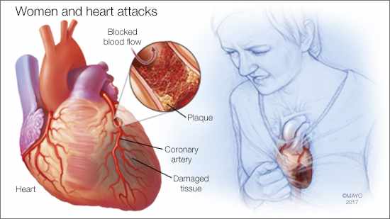 a medical illustration of women and heart attacks