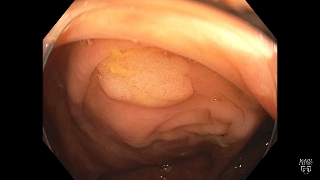 colonoscopy scope camera view of the colon and polyp