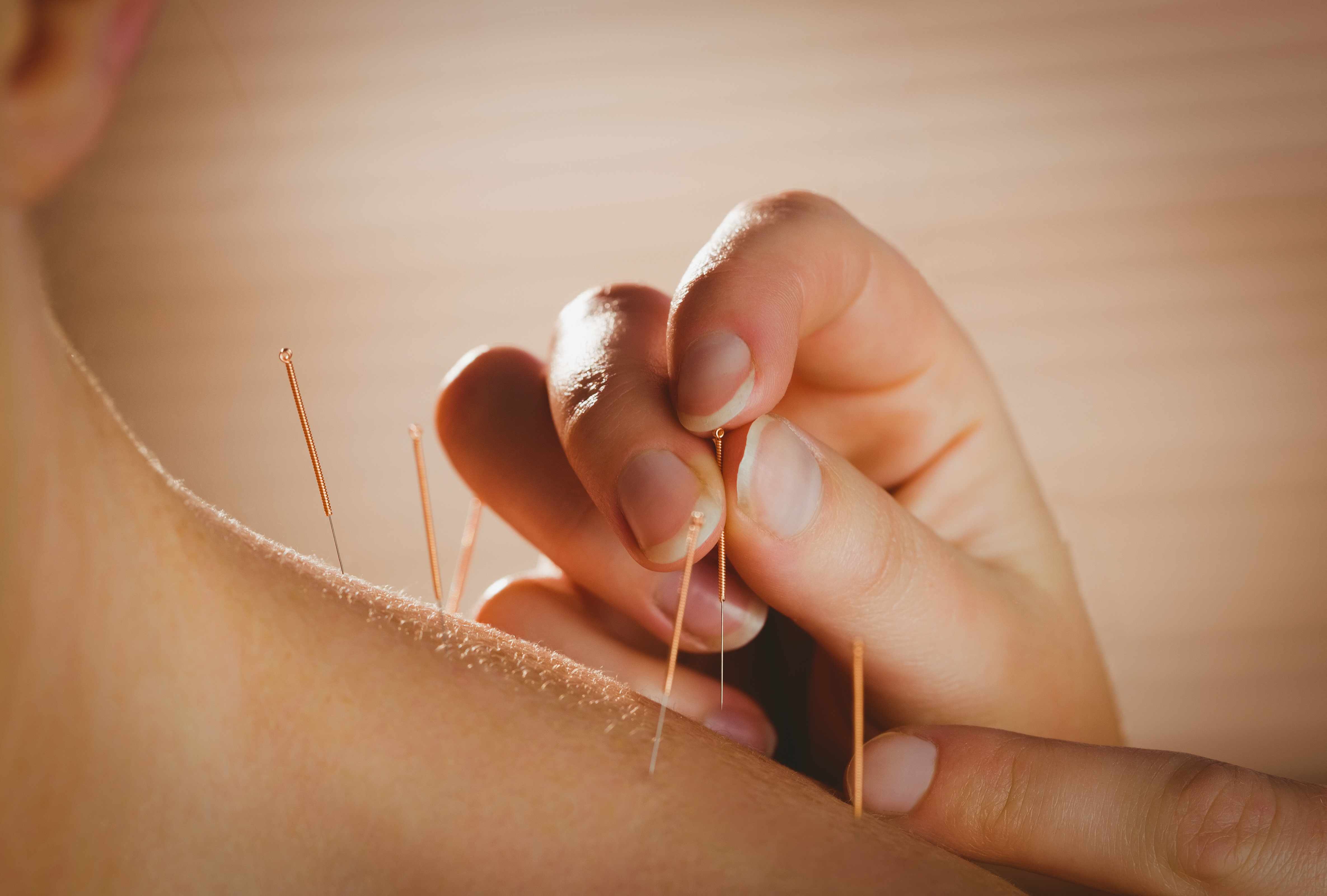 a close-up of the application of acupuncture needles to a person's upper back and neck region
