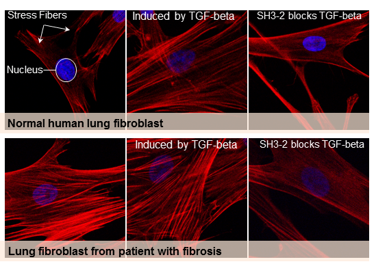 comparing normal lung fibroblast with lung fibroblast from patient with fibrosis