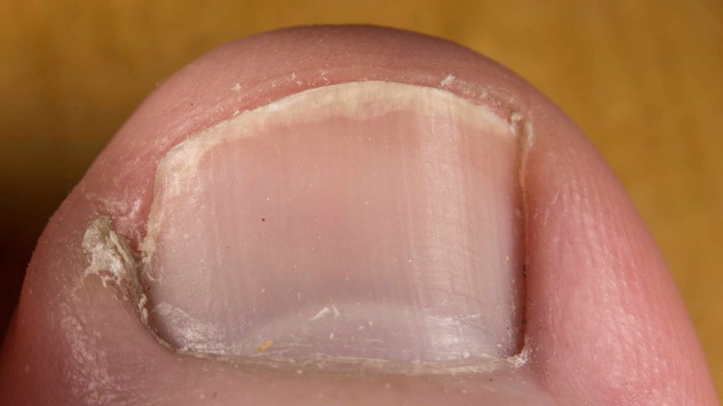 Un dedo gordo con una uña encarnada