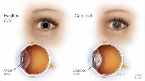 a medical illustration of a healthy eye and one with a cataract