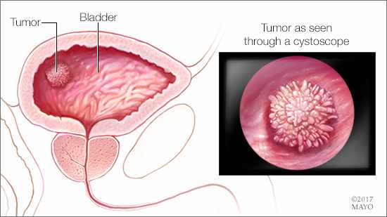a medical illustration of bladder cancer