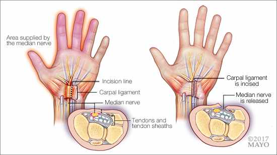 a medical illustration of carpal tunnel surgery