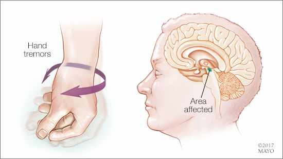 a medical illustration of the hand tremor associated with Parkinson's disease and the affected area of the brain
