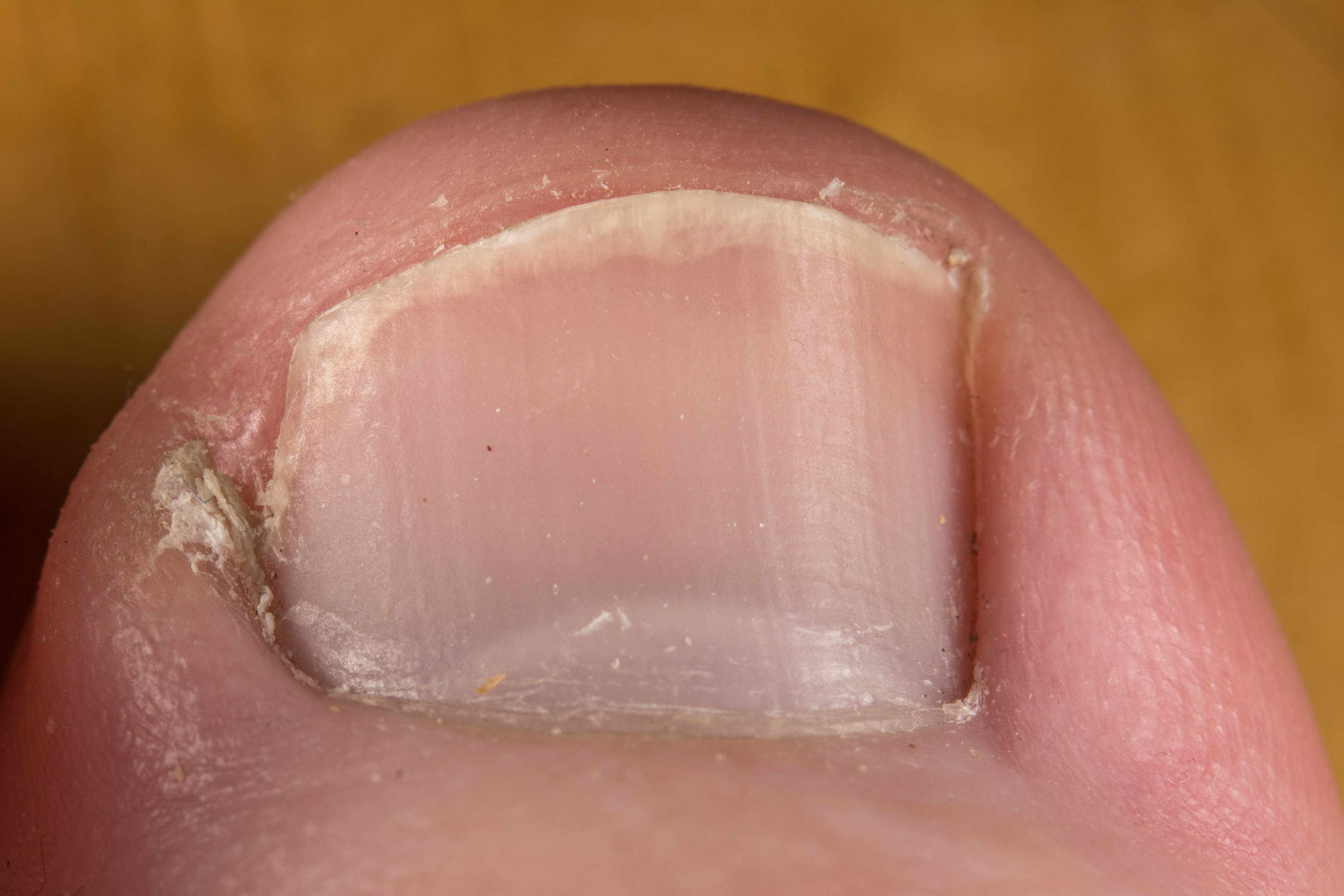 Pain in the Pinky Toe