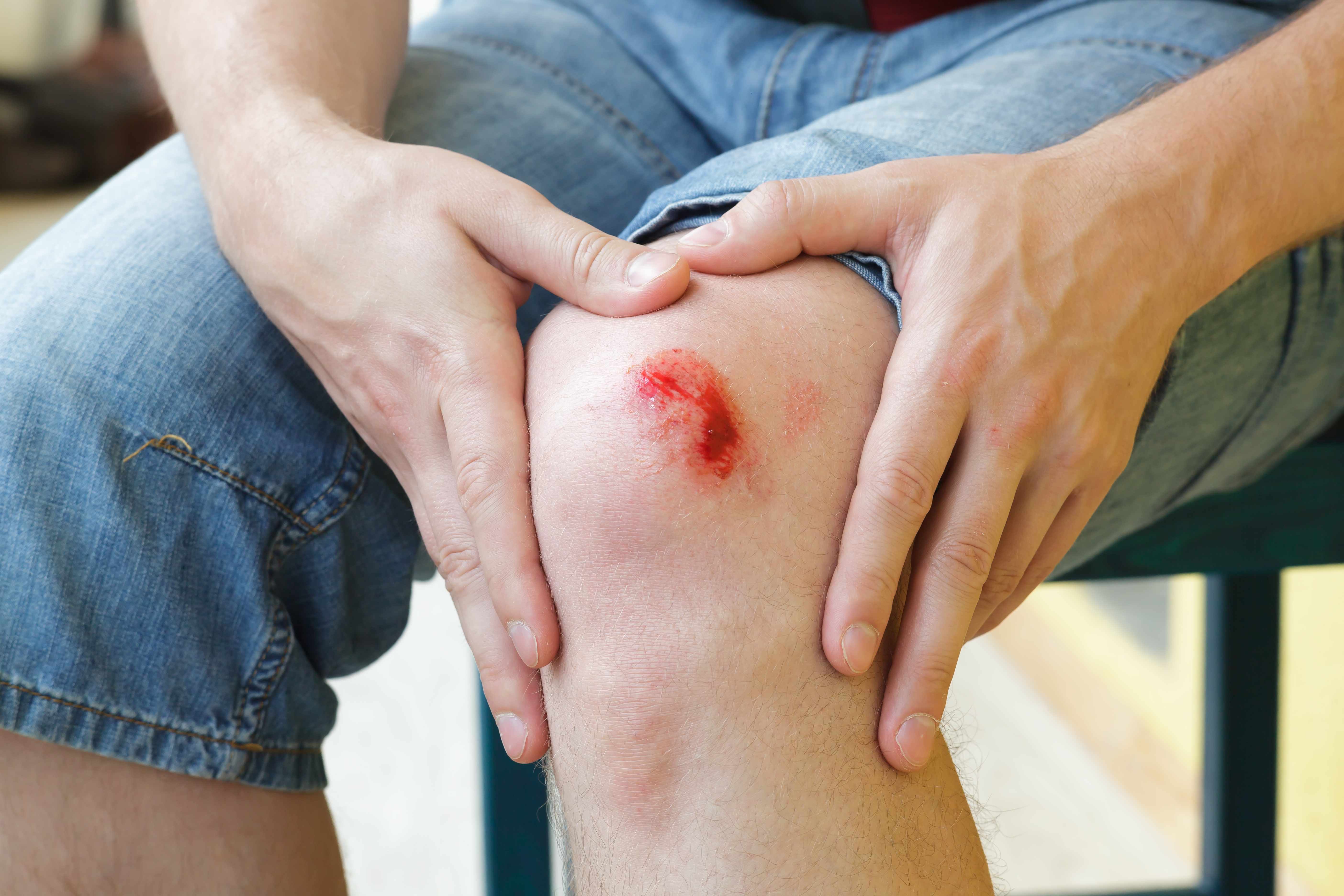 a person holding his or her knee that has been scraped and is bleeding