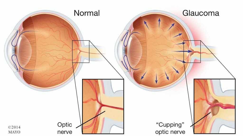 ilustración médica de la anatomía de un ojo normal y de otro con glaucoma
