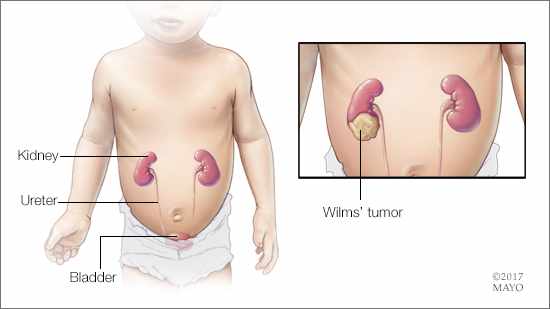 a medical illustration of a child with a Wilms' tumor
