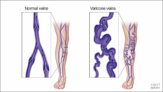a medical illustration of a leg with normal veins and one with varicose veins