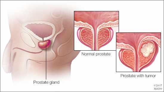 Ilustración médica de una próstata normal y otra con un tumor