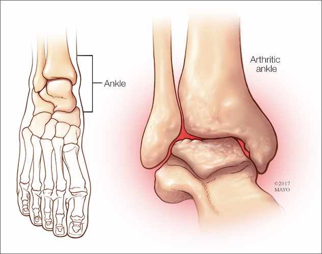 a medical illustration of ankle arthritis