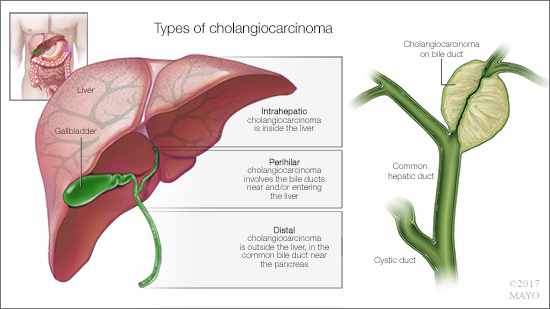 a medical illustration of cholangiocarcinoma