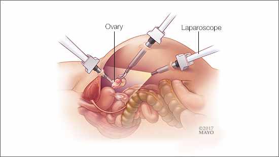 a medical illustration of oophorectomy - surgical removal of an ovary