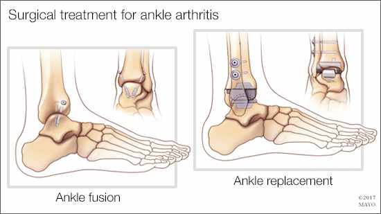 a medical illustration of surgical treatments - ankle fusion and ankle replacement - for ankle arthritis