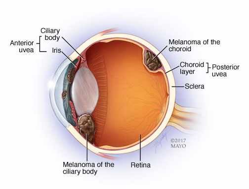 illustration of eye melanoma