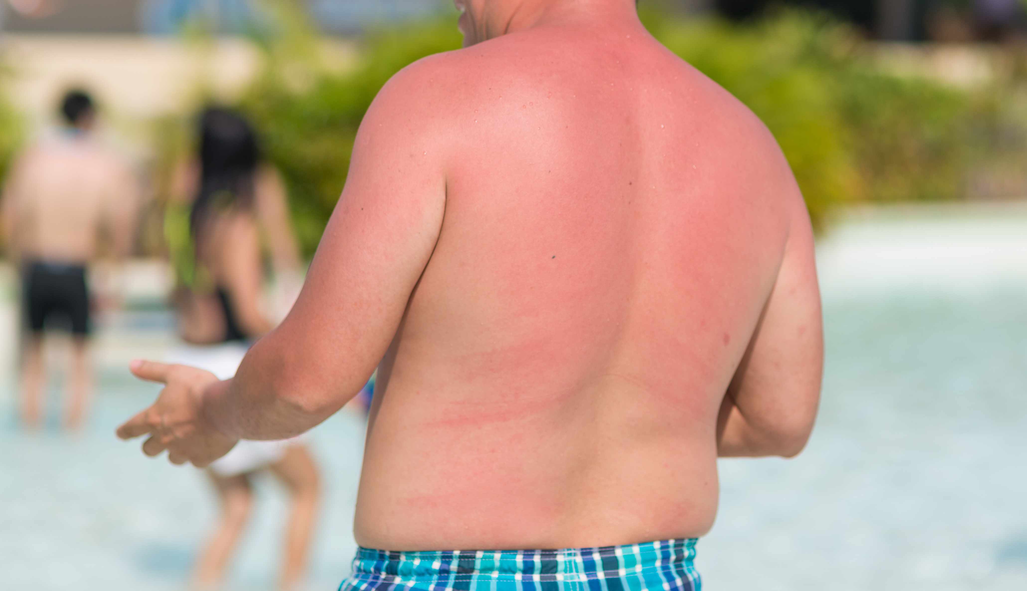 a man on the beach in a bathing suit with a bare sunburned back