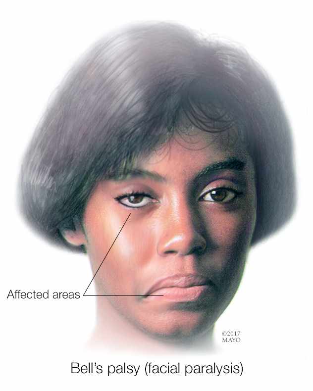 a medical illustration of an African American woman with Bell's palsy facial paralysis 