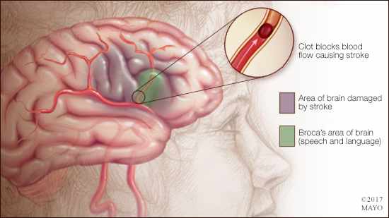 a medical illustration of a stroke in Broca's area of the brain (speech and language)